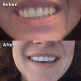 Pearlora™ Whitening Strips — Whiter Teeth After One Use